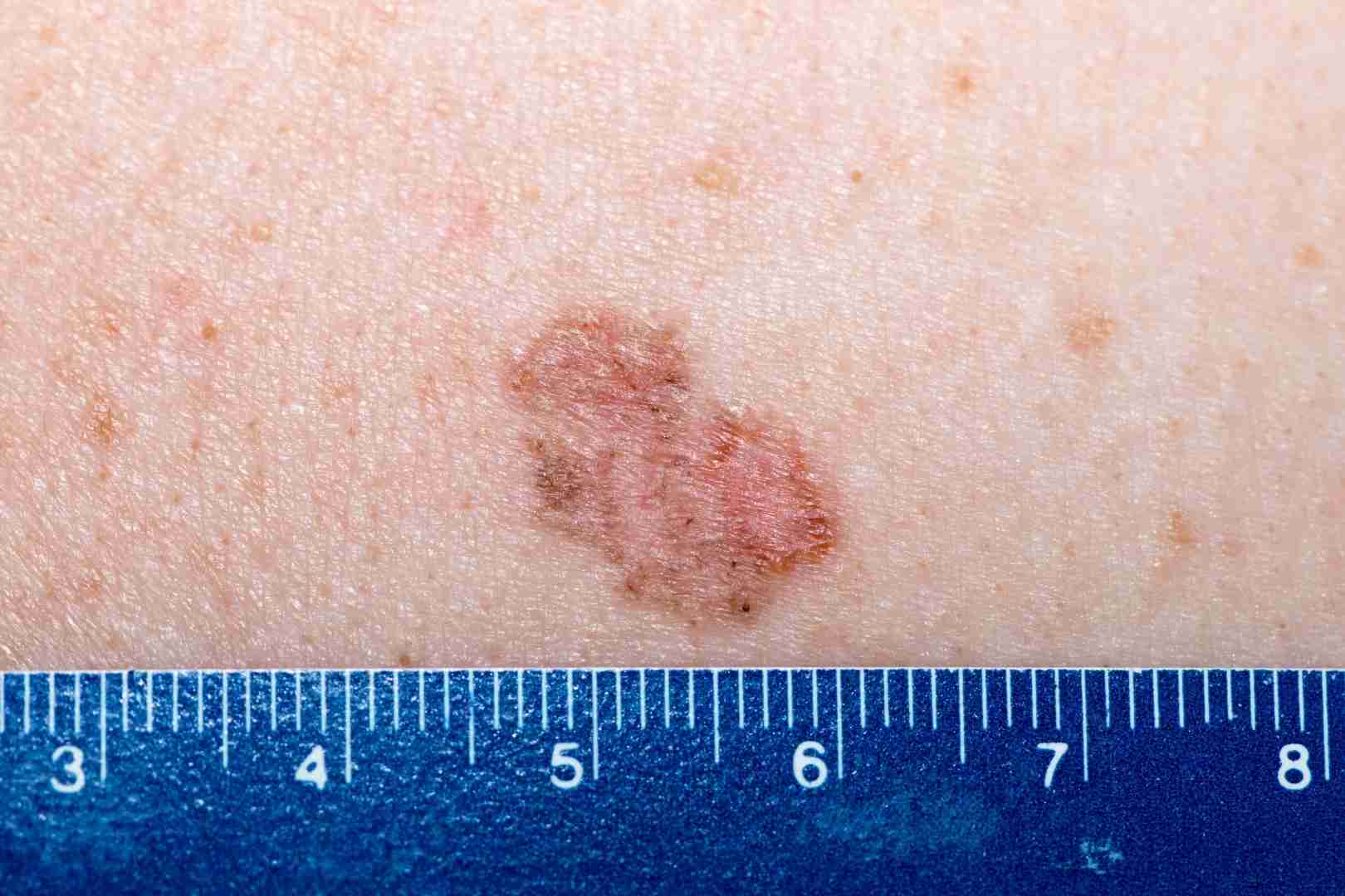 Carcinoma Basocelular El Tipo De Cáncer De Piel Más Común